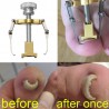 EquiposCorrector de uñas ingrown profesional - elevador - acero inoxidable