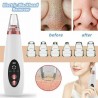 PielEliminador de puntos negros / acné - Limpiador de poros faciales - Cuidado facial con succión al vacío - USB
